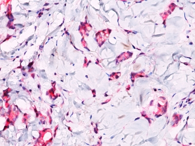 FFPE breast carcinoma, lobular sections stained with 100 ul anti-beta-Catenin (clone Polyclonal) at 1:400. HIER epitope retrieval prior to staining was performed in 10mM Tris 1mM EDTA, pH 9.0.
